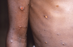 200명 넘게 사망한 무서운 그 바이러스 또···아시아서 '새 변이' 발견됐다