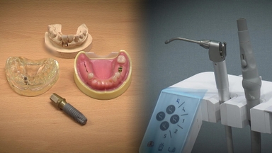 "임플란트 덜컥 결제했다가"…치과 선납진료비 분쟁 급증