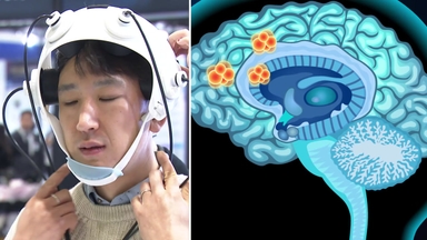 "초음파로 뇌 청소"...치매 치료기기 나온다